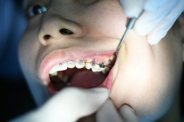 Durée du traitement orthodontique : à quoi s'attendre pour votre sourire